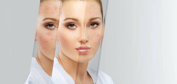 Laser skin resurfacing for acne scars